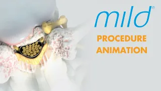 Mild Procedure Animation | Lumbar Spinal Stenosis (LSS) Treatment