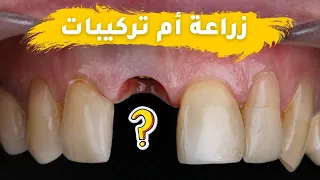 زراعة الأسنان vs تركيبات الأسنان: أيهما أفضل ؟