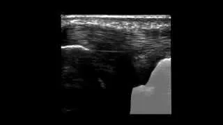 Musculoskeletal Ultrasound: Wrist 6: dorsal longitudinal scan (ulnar)