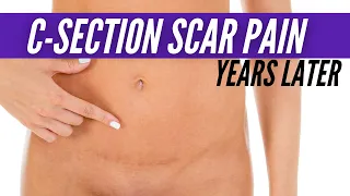C Section Scar Pain Years Later | HOW C-SECTION SCAR MASSAGE CAN HELP + HOW TO DO IT
