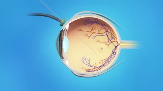 Macular Hole: Vitrectomy Surgery