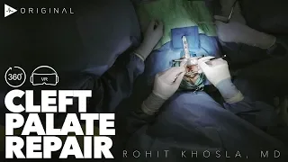 Cleft Palate Repair Using Double Opposing Z-Plasty Technique - Dr. Rohit Khosla