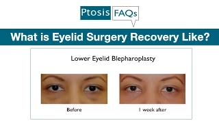 What is Eyelid Surgery Recovery Like When Performed by Oculofacial Plastic Surgeon Dr. Amiya Prasad