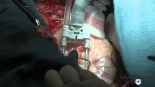 Beating Heart Surgery