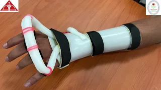 Fabrication Of Customized Radial Nerve Palsy Splint Video - Dept. Of Occupational Therapy | SRMC