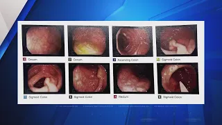 St. Louis doctor's been telling patients to get colonoscopy by age 45 for years, US government now a