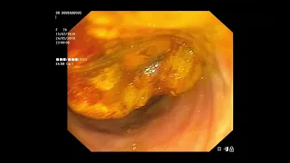 Urgent ERCP  for a 79 years old woman, acute cholangitis with septic chock,Dr Sami boudabbous.