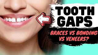 Close Gaps Between Teeth | Black Triangles SOLUTIONS