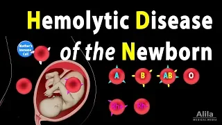 Hemolytic Disease of the Newborn (HDN), Animation