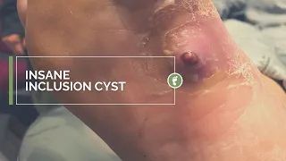 INSANE INCLUSION CYST