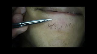 Extractions Ingrown Hair l Tweezers Beard l 2020/7/23