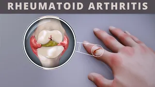 Rheumatoid Arthritis-  causes, symptoms and treatment.