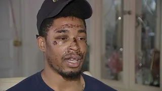 Man severely beaten after leaving bar: 'I don't remember any of it'