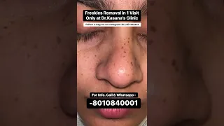 Freckles Removal 1 Visit only at Dr. Kasana's Clinic