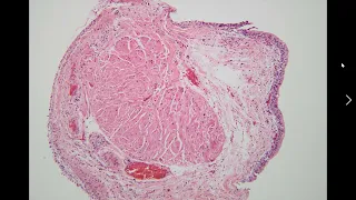 GU Pathology: Bladder