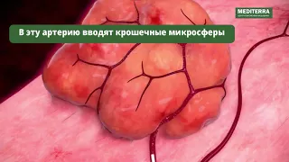 Эндоваскулярная эмболизация геморроидальных узлов