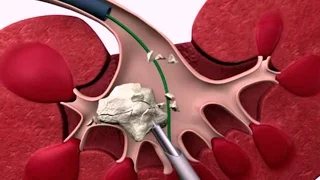 Перкутанная нефролитотрипсия под ультразвуковым контролем - оперативная техника