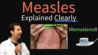 Measles Symptoms, Diagnosis, Vaccine, Treatment Explained