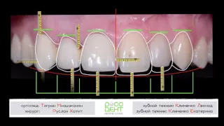 Малоинвазивная эстетическая реабилитация фронтальных зубов при помощи виниров и коронок.