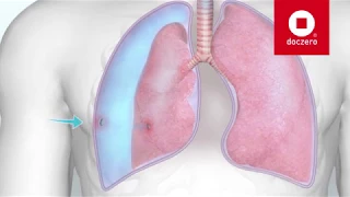 Open pneumothorax | Doczero E-learning