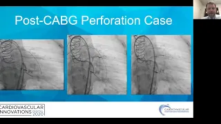 CTO PCI in prior CABG patients-Robert Riley, MD