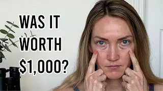 Treatments for Dark Under Eye Circles | Results with Before & Afters