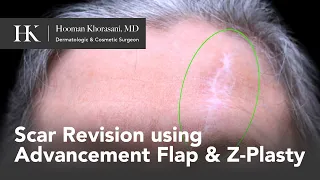 Forehead Scar Revision using Advancement Flap and Z-Plasty | Dr. Hooman Khorasani