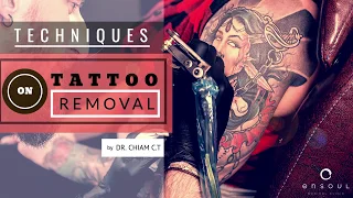 Remove Unwanted Tattoos with Medical Lasers | Dr Chiam CT