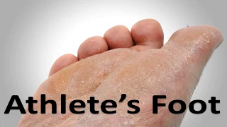 Athlete's Foot Fungus Cure in 3 Minutes! **Simple Home Trick**