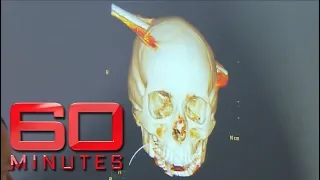 Teen survives after steel pole speared through skull | 60 Minutes Australia