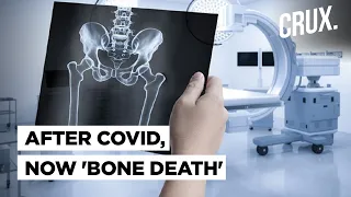 After Black Fungus, now ‘Bone Death’ Scare Emerges: New Post Covid Complication Explained