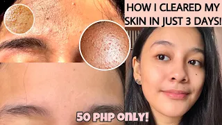 HOW TO GET RID OF TINY BUMPS ON FOREHEAD/FACE FAST | FUNGAL ACNE (how i cleared my skin) [ENG SUB]