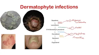 Dermatophytes (Ring worm): Superficial fungal infection: Dermatology