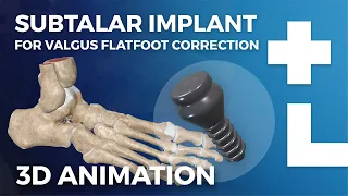 Subtalar implant procedure (arthroereisis) - flexible flatfoot surgery animation - Dworska hospital®