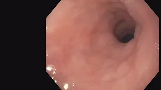 Zenkers Diverticulum -  endoscopic diverticulotomy - tips & tricks