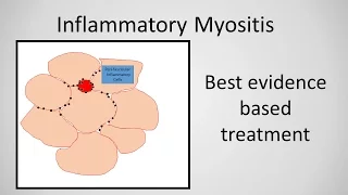 Myositis (Inflammatory Myopathy) Treatment