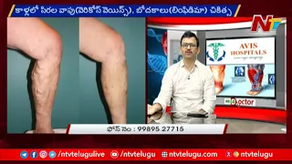 Varicose Veins: Treatment, Cause, Symptoms and Treatment - Dr. Rajah V Koppala | Avis hospitals