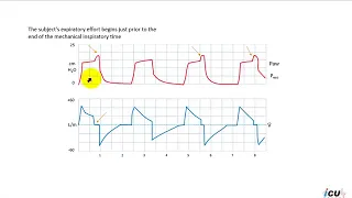 Termination Asynchrony on Mechanical Ventilation