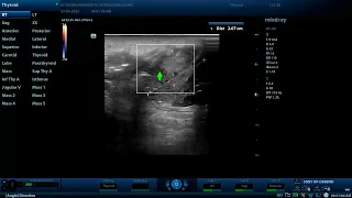 Scrotal cellulitis with subcutaneous emphysema Diagnostic ultrasound case