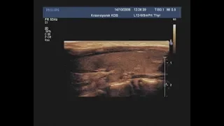 Видеозапись УЗИ - Добавочная долька по заднему контуру щитовидной железы