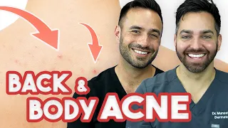 BACK ACNE - How to Treat and Prevent It | Doctorly Routines