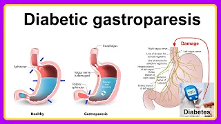 diabetic gastroparesis