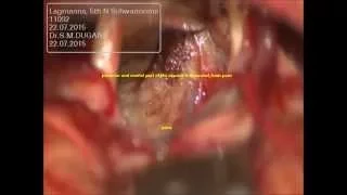 TRIGEMINAL SCHWANNOMA-microsurgery-dr suresh dugani/HUBLI/KARNATAK/INDIA