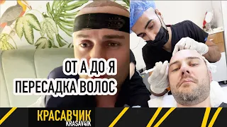 Пересадка волос в Турции от А до Я: Это больно? Есть ли эффект? Испытываю на себе / Красавчик