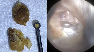 58 - Incredible view of Anvil (Incus) Bone After Jobson Horne Ear Wax Removal