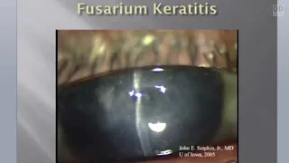 Ocular Side Effects of Systemic Drugs - Dr. Richard Witlin