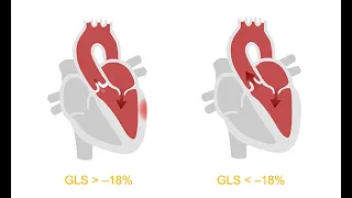 Analyzing ventricular dysfunction with the help of strain imaging echocardiography