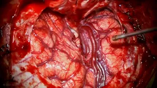 Orbitozygomatic Craniotomy and Transsylvian Approach for Resection of Super Basilar Pontine Cav Mal