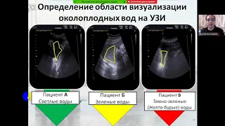 УЛЬТРАЗВУКОВАЯ ДИАГНОСТИКА ГИПОКСИИ ПЛОДА