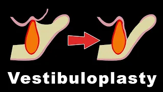 Vestibuloplasty - Kazanjian, Lip Switch, Clark's, Maxillary Pocket inlay